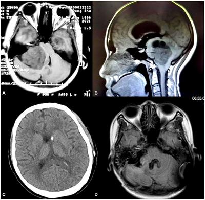 Large vestibular schwannomas presenting in the late state of pregnancy: a case report and literature review